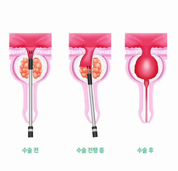 양성 전립선 비대증의 부작용을 줄이기 위한 진단 치료법 찾기